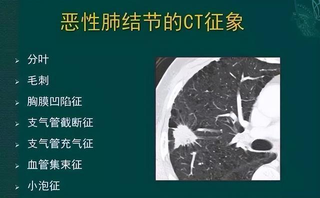 如何判米乐m6断单发肺结节和多发肺结节的危险程度？上海太安医院告诉你(图3)